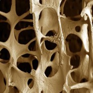 A nma jrvny - a csontritkuls nem csak a nk betegsge