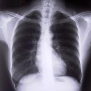 A fiatalabb betegeknl is hatkony az j COPD terpia