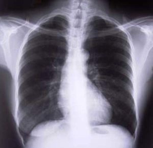 Krnikus khgs: asztma, COPD, daganat jele is lehet