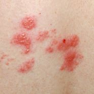 Slyos allergis reakci - az angiodma