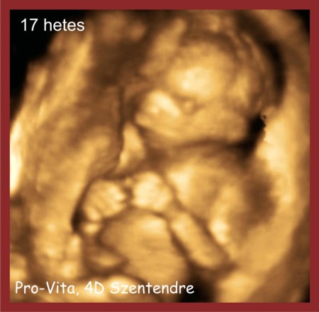 17 hetes 4d ultrahang