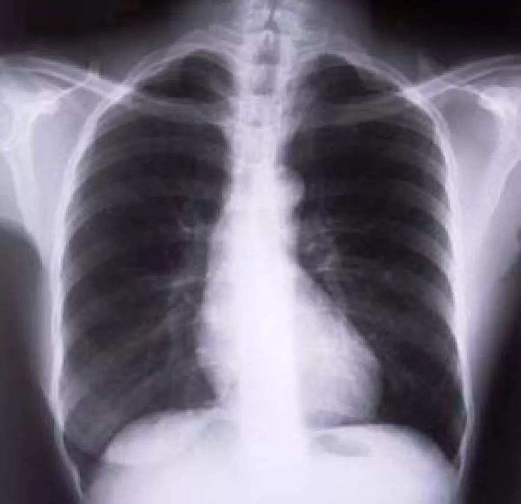 Krónikus köhögés: asztma, COPD, daganat jele is lehet