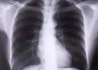 Krónikus köhögés: asztma, COPD, daganat jele is lehet