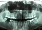 Mit mutat a panoráma röntgen?