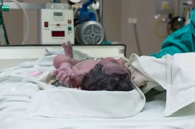 Agyhalott asszony babáját segítették világra a Semmelweis Egyetemen