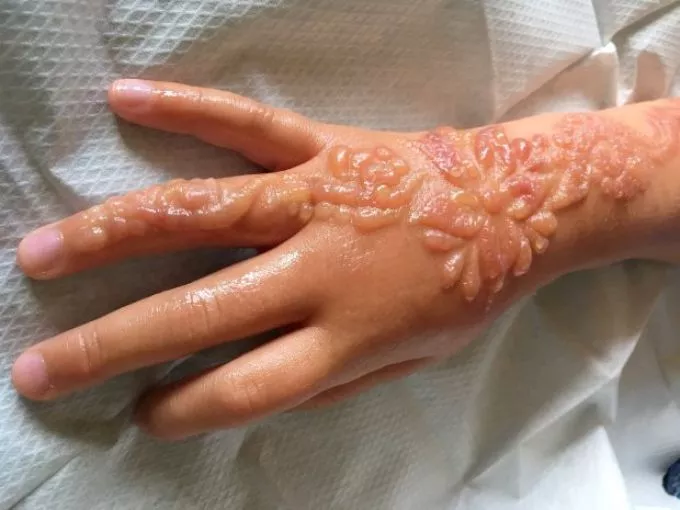 Horrorba illő hegek maradtak egy kislányon a hennafestés nyomán