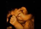 Mit csinál a magzat az anyaméhben? - 4 tündéri ultrahang felvétel