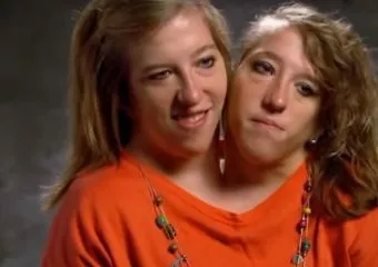 Közös testben is különálló egyéniségek: így él Abigail és Brittany, az amerikai sziámi ikerpár