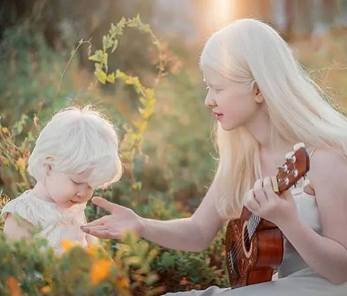 12 év korkülönbséggel születtek az albínó testvérek. Az egész világ a szépségüket csodálja!