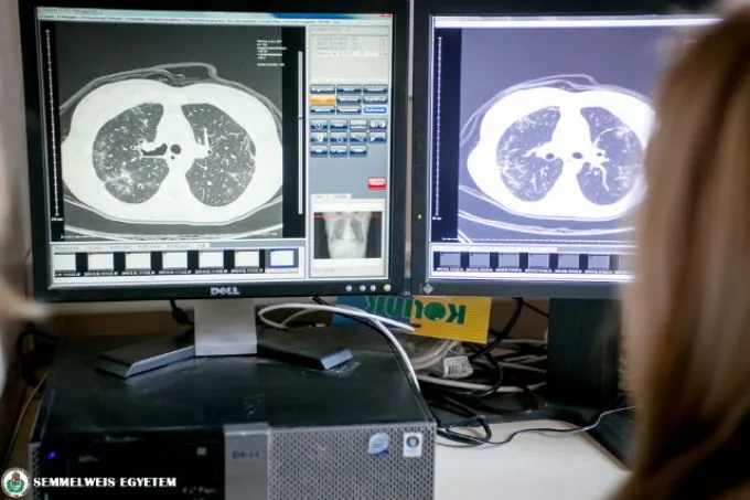 Asztma, allergia, COVID-19 - központban a tüdő betegségei