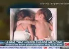 Az életmentő ölelés - haldokló koraszülött ikertestvérét mentette meg ölelésével a kisbaba