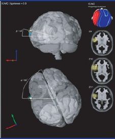 Valentin s epilepszia