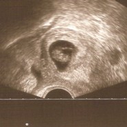 A korai felismers dnt jelentsg - az ultrahang-diagnosztika lehetsgei