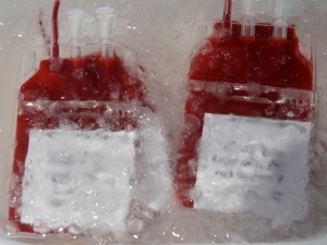 Hírek · Csontvelő transzplantáció - életet menthet az egyszerű vérvétel · PTE ÁOK