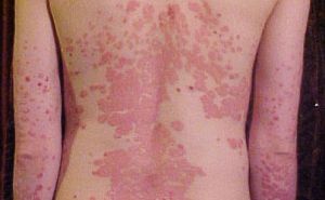 pikkelysömör a fejn termszeti kezels is psoriasis hereditary