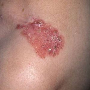Melanoma bőrrák - lelki háttere - Kínai medicina