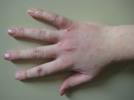 3 bőrbetegség, amit súlyosbít a stressz 