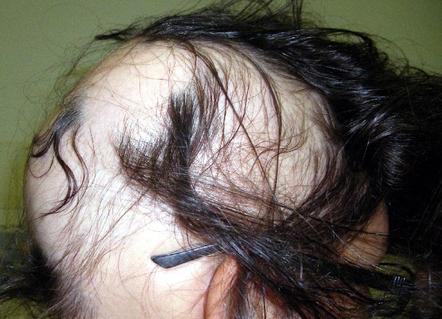 Miért hullik a hajam szülés után? | Családinet.hu