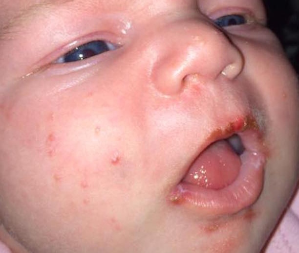 herpeszfertzs csecsemkorban 
