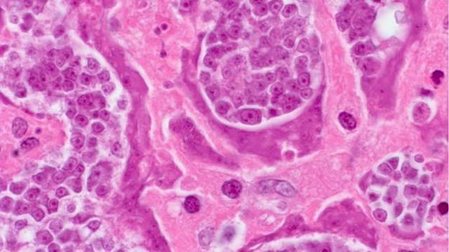parazita daganatos sejt kimutatsa embernl