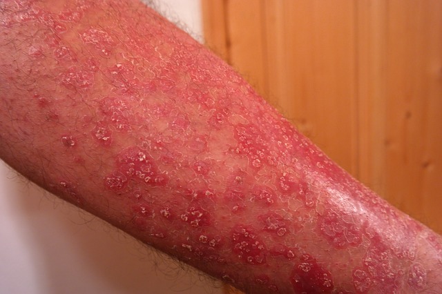 pikkelysömör kezelés bolt vörös foltok jelentek meg a hátán, tuberkulákkal viszketve mi ez