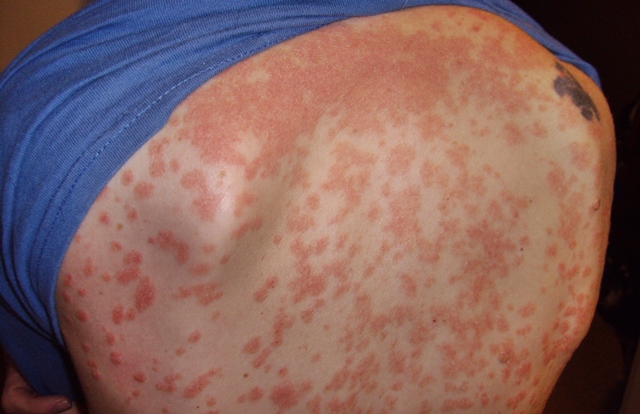 Pikkelysömör (psoriasis) tünetei, kezelése