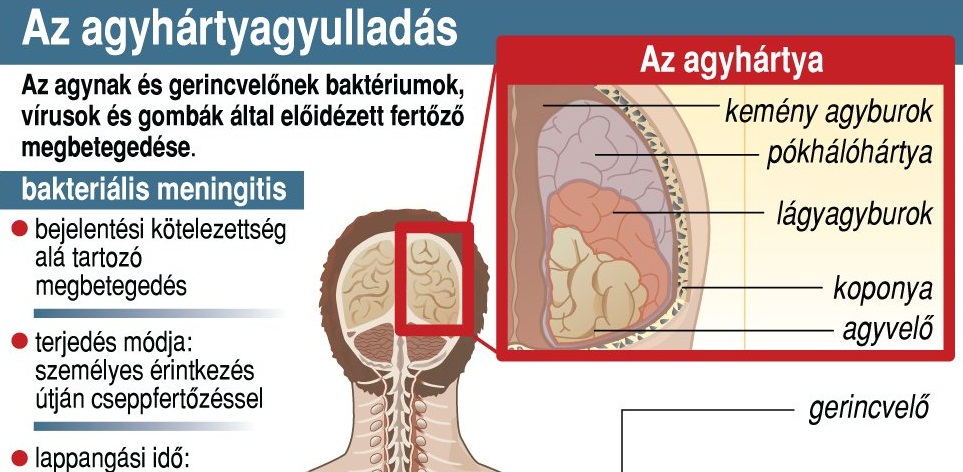 az agyhártyagyulladás hatása a látásra)