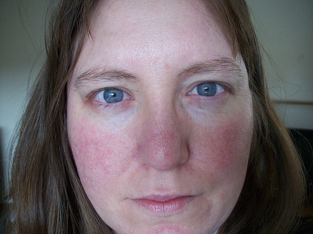 rosacea