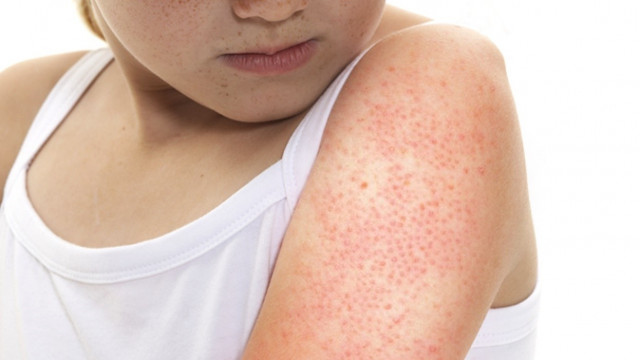 keratosis pilaris keratosis pilaris
