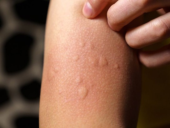 Csalánkiütés (urticaria) Csalánkiütés (urticaria)