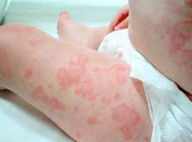 Csalánkiütés (urticaria) Csalánkiütés (urticaria)