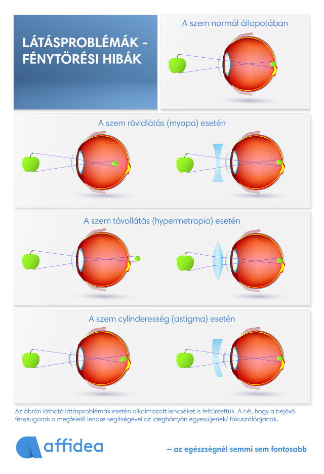 Látásproblémák, fénytörési hibák