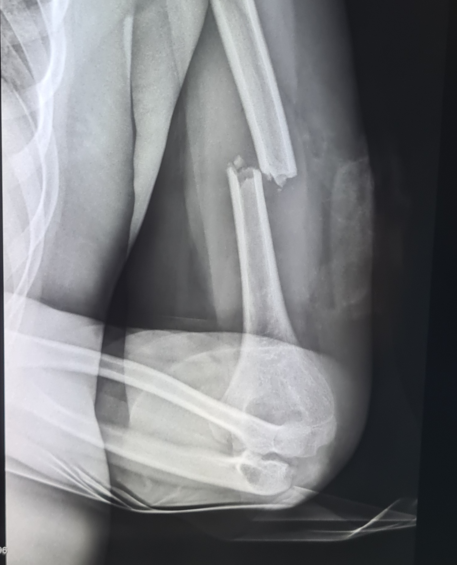 Egy nap alatt h�rom gyerek is s�lyos balesetet szenvedett elektromos rollerrel