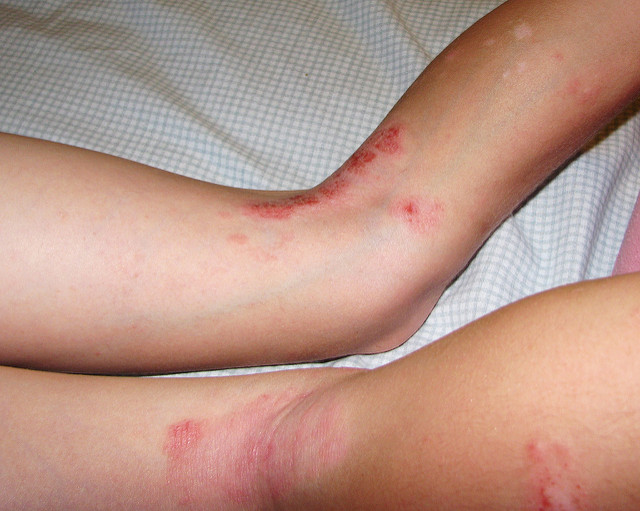 vörös foltok a lábon és a hason a pikkelysömör antibiotikumokkal kezelt?