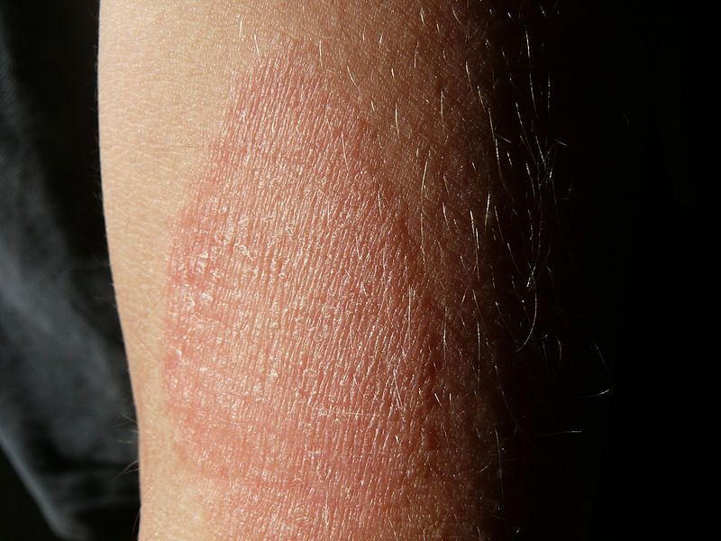 Lappangó betegségeket is jelezhetnek a bőrtünetek