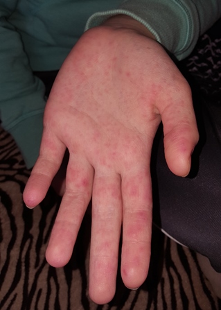 a jobb kezén piros folt jelent meg korpásodás és pikkelysömör kezelése népi gyógymódokkal