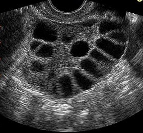 PCOS (policiszts ovrium szindrma) ultrahang