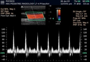 Ultrahangos keringésvizsgálat - 
Doppler görbe