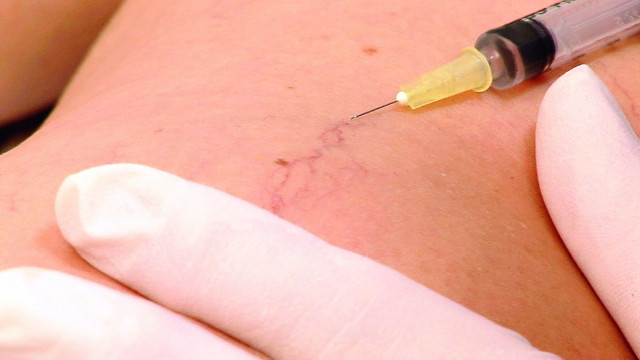 Visszérműtét vagy injekciós kezelés? 1. rész | TermészetGyógyász Magazin