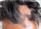Stressz-hajhullás -pajzsmirigybetegség