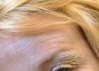 A lézerkezelés nem Botox!