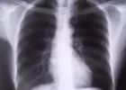 November 18. - COPD Világnap