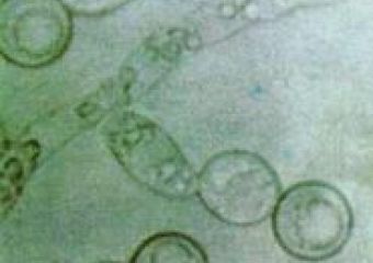 Tudj meg többet a Candida–fertőzésről!