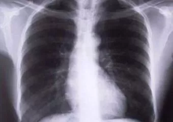Krónikus köhögés: asztma, COPD, daganat jele is lehet