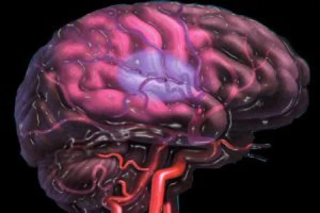 Bizonyítottan költséghatékony új stroke prevenciós terápia pitvarfibrillációban