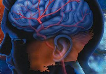 Új terápia segíti a pitvarfibrilláció okozta stroke megelőzését