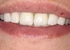 Új allergén a fogászatban: a titánium