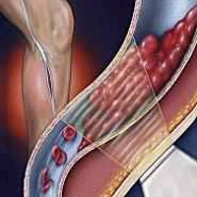 A trombózis nem csak a láb vénáit veszélyezteti
