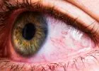 Egyre gyakrabban marad meg egész évben a szempirosság, viszketés az allergiásoknál