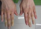 Az elszíneződő ujjak betegségre is utalhatnak